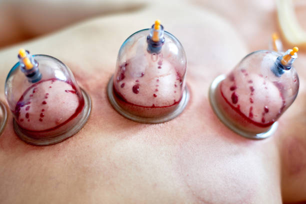 Cupping Therapy/Hijama Therapy